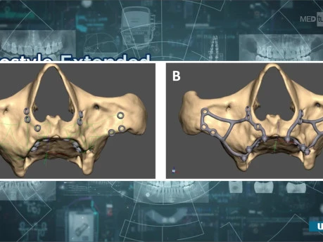 How Subperiosteal Dental Implants are Made