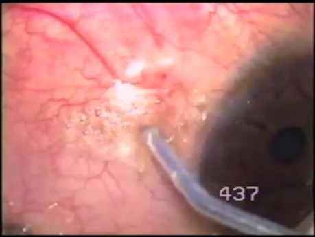 Bitot's spots removal
