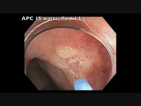 APC Of Radiation Telangectasia In Rectum