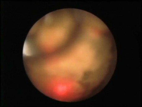 Ureteroscopy