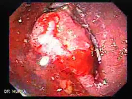 Early Gastric Cancer - Endoscopy (1 of 21)