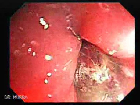 Endoscopic view of Rectal Stalked Polyp (6 of 7)