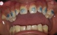 Braces Bonding Step by Step in Orthodontics & Wire Insertion