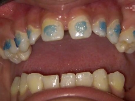 Braces Bonding Step by Step in Orthodontics & Wire Insertion
