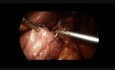 How to do a Laparoscopic Gastric Plication LGCP with Anti Reflux Procedure