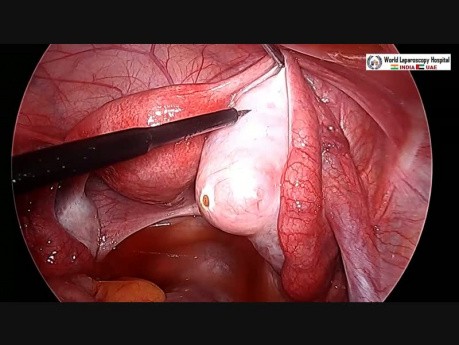 Diagnostic Laparoscopy, Hysteroscopy and Dye Test for Infertility