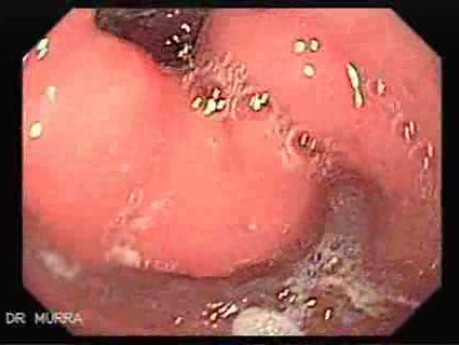 Duodenal Ulcer (1 of 5)
