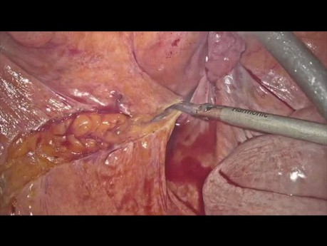 Complicated Diverticulitis with Colovescical Fistula
