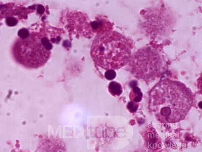 High power detail of E. histolytica trophozoites with
 eritrocytes inside.