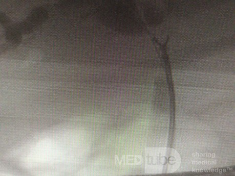 Direct Cold Forceps Biopsy from Hillar Cholangiocarcinoma Under Fluoroscopy