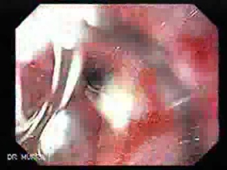 Esophageal Stricture Due To Reflux Esophagitis - 57-year-old Male