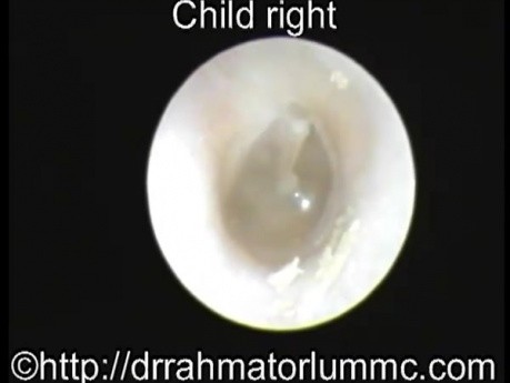 The View of An Adult and A Child's Eardrum