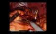 Robotic Gastrectomy, Splenectomy, and Distal Pancreatectomy for Gastric Mass