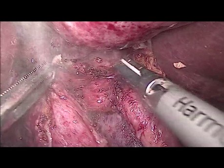 Laparoscopic Completion Radical Cholecystectomy and Lymphadenectomy for Gallbladder Cancer