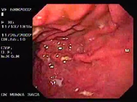 Multiple Gastric Ulcers  - 86 Years-Old Female