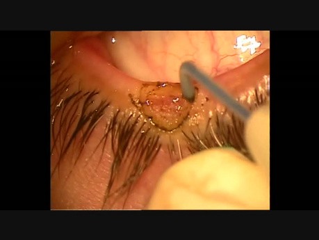 Bloodless excision of lid margin benign growths with Fugo plasma blade