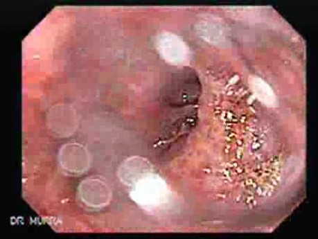 Severe Reflux Esophagitis - Esophagoscopy