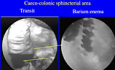 Role of Sphincters of the Oesogastrointestinal Tract