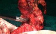 Supracolic Removal of the Omentum for Ovarian Cancer by Use of Sealing of Blood Vessels