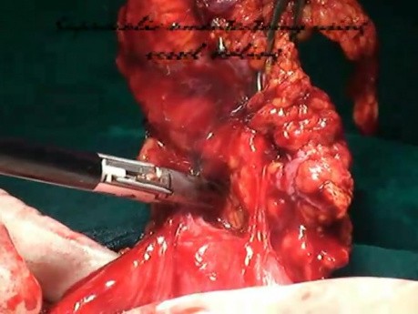 Supracolic Removal of the Omentum for Ovarian Cancer by Use of Sealing of Blood Vessels