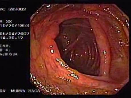 Cecum