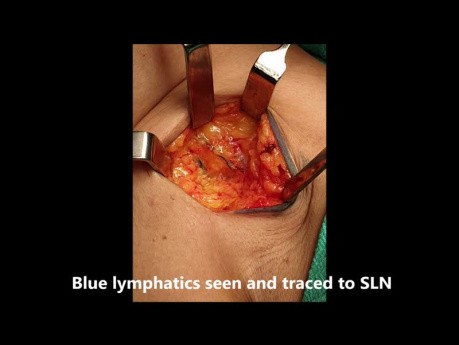 Sentinel Lymph Node Biopsy in Breast Cancer