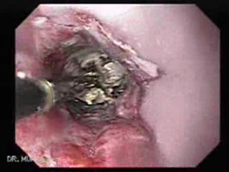Adenocarcinoma of the Gastroesophageal Junction - Removal of Necrotic Tissue After Recanalization
