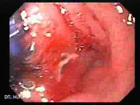Esophagus - Pneumatic Dilation for Achalasia - Small Bleeding