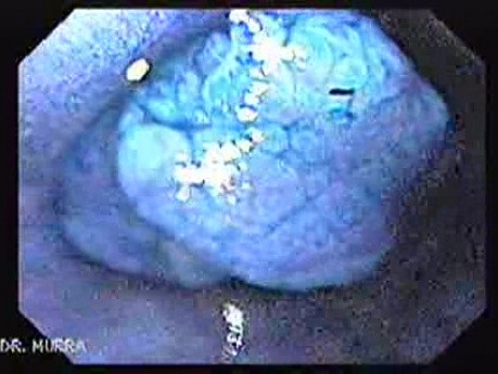 Chromoendoscopy Of The Esophagus - Magnified Multi-lobulated Papilloma - 2/4