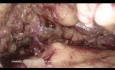 Retroperitoneoscopic Radical Nephrectomy