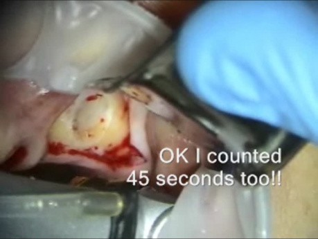 Implant Microsurgery featuring Zimmer Sinus Lateral Approach Kit