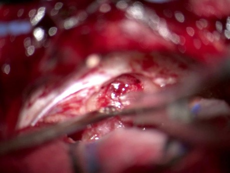 IAC Drilling for VS Resection 