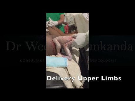 Real Time Assisted Vaginal Breech Delivery for Primi - Steps 
