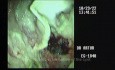 EUS cystogastrostomy