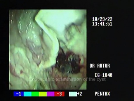 EUS cystogastrostomy