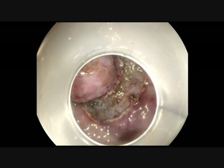 Endoscopic Resection of Cardia GIST