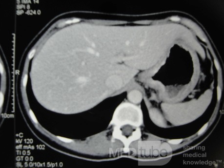 Endoscopy of Scirrhous Gastric Carcinoma involving the entire Fundus, Body and the Antrum (20 of 47)