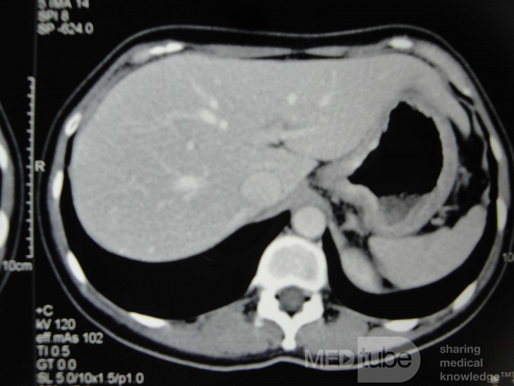 Endoscopy of Scirrhous Gastric Carcinoma involving the entire Fundus, Body and the Antrum (20 of 47)