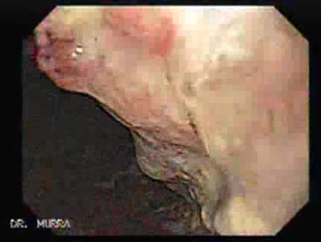 Adenocarcinoma of the Corpus and Antrum (3 of 5)