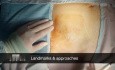Emergency Femoral Hernia