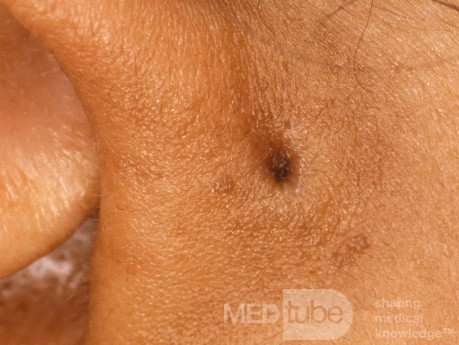 Preauricular Pit