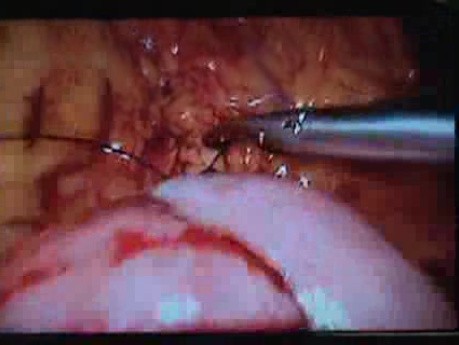 Jejunal Gastrointestinal Stromal tumor (GIST) (36 of 86)