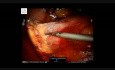 Robotic excision of a large retroperitoneal schwannoma