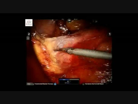 Robotic excision of a large retroperitoneal schwannoma