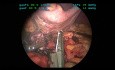Laparoscopic Resection of the Splenic Artery for Treatment of 4 Splenic Artery Aneurysms