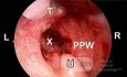 Secondary Post-Tonsillectomy Bleeding