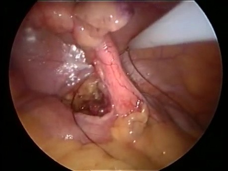 SILS appendectomy