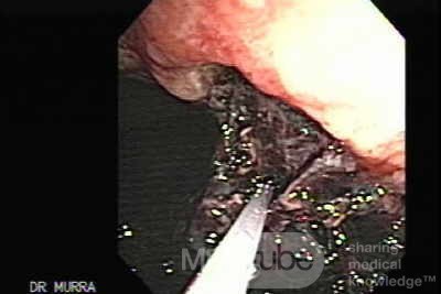 Gastric Cancer - Injections of Absolute Alcohol