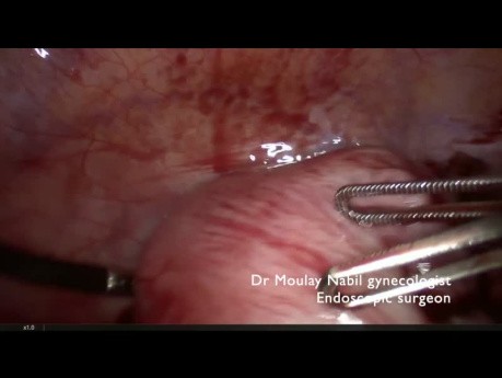 Laparoscopic Myomectomy for Resident