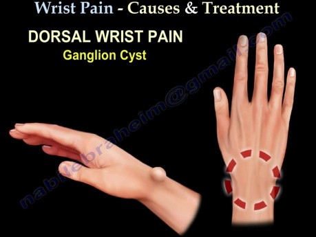 Causes and Treatment of the Wrist Pain - Part 2